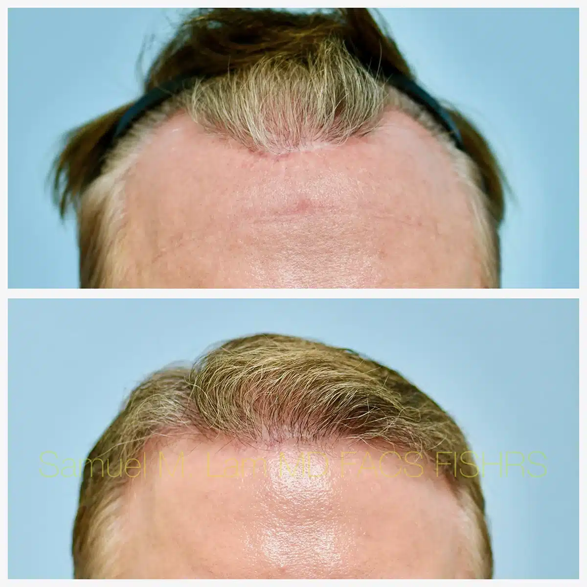 Hairline and Central Density Before and After Photo by Dr. Lam in Plano TX