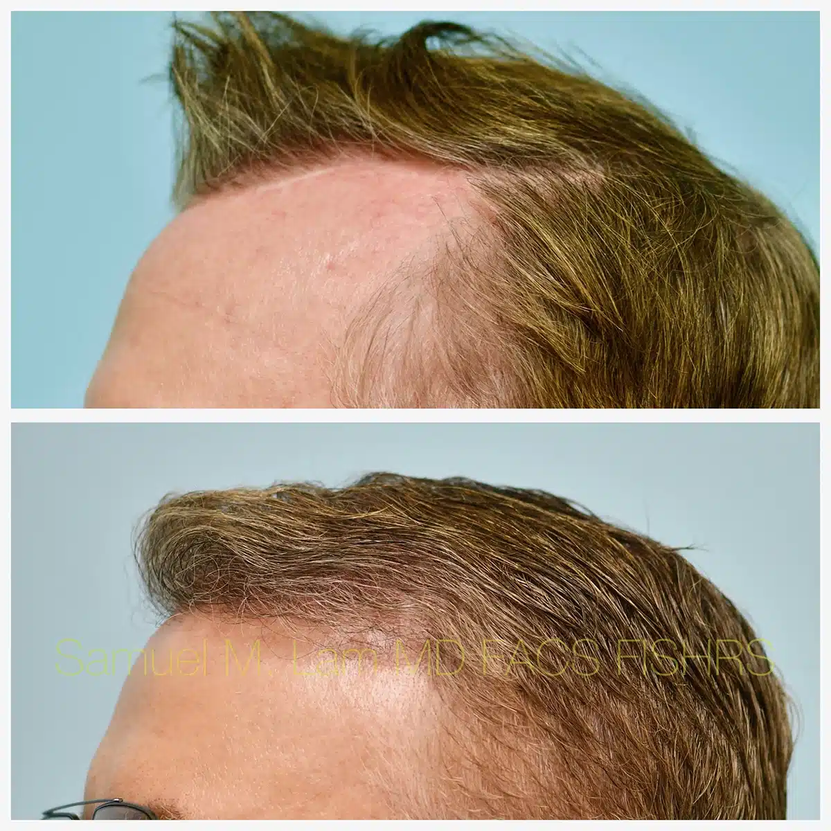 Hairline and Central Density Before and After Photo by Dr. Lam in Plano TX