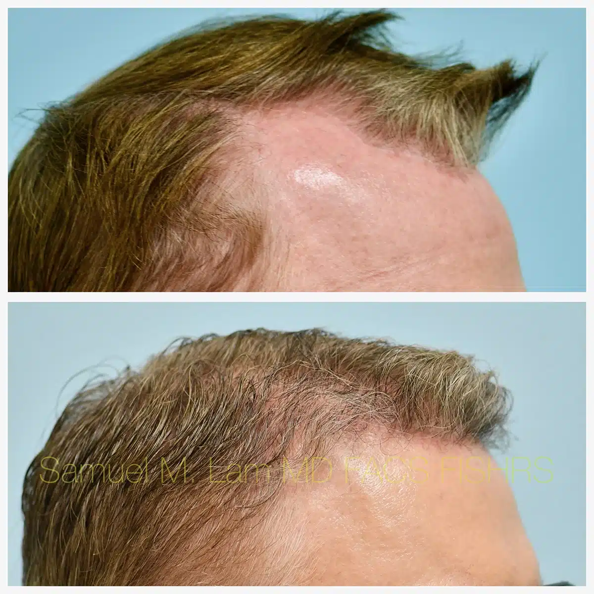 Hairline and Central Density Before and After Photo by Dr. Lam in Plano TX