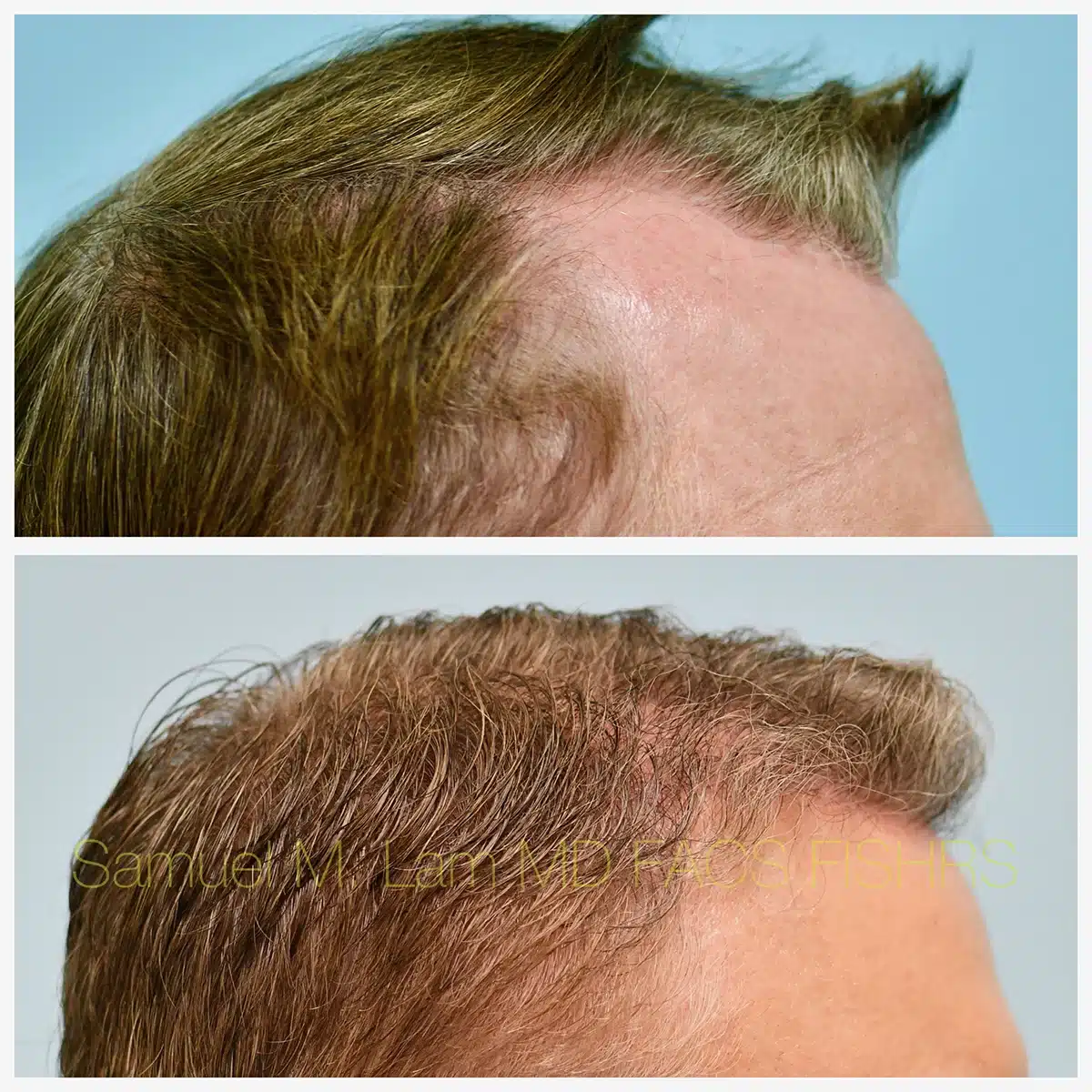 Hairline and Central Density Before and After Photo by Dr. Lam in Plano TX