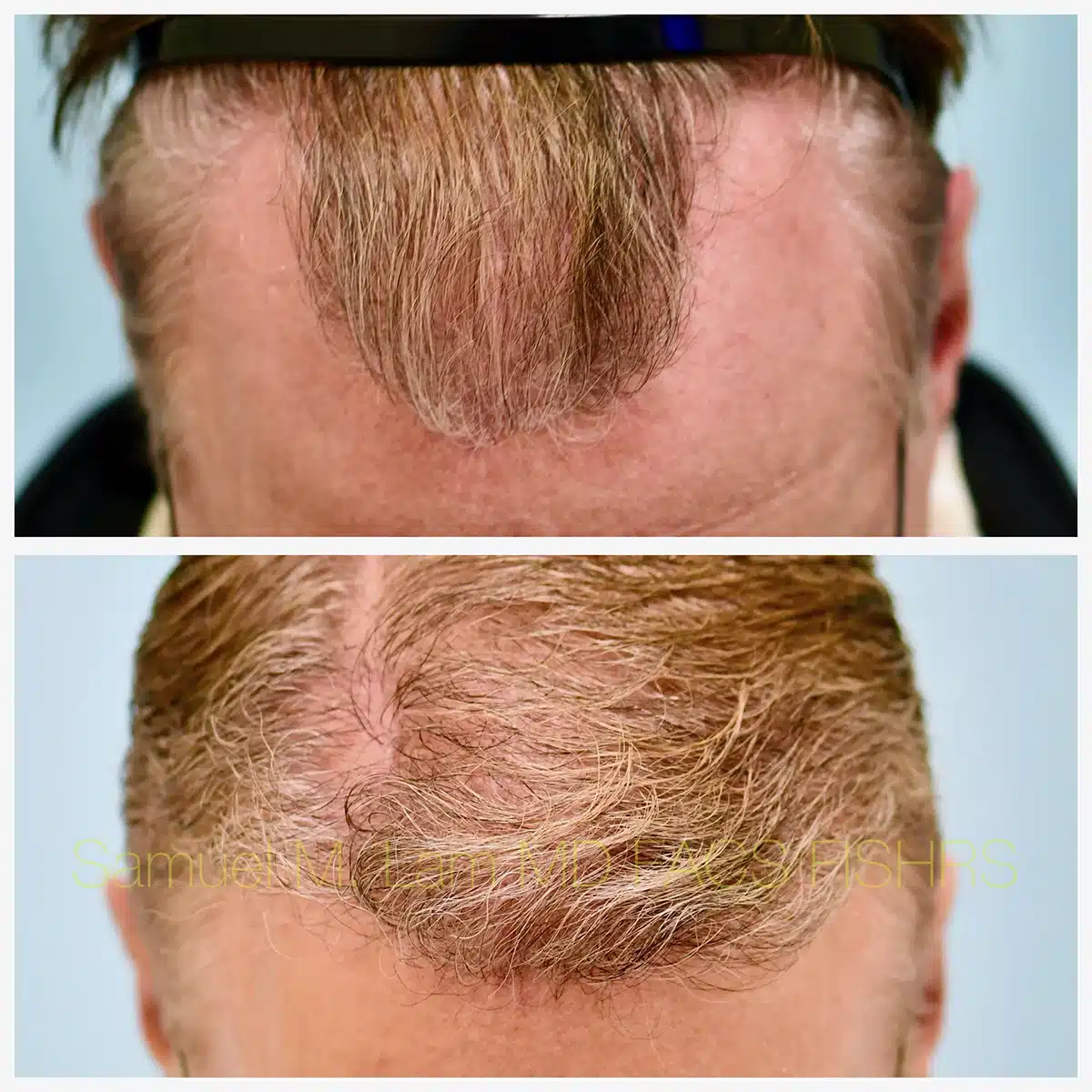 Hairline and Central Density Before and After Photo by Dr. Lam in Plano TX