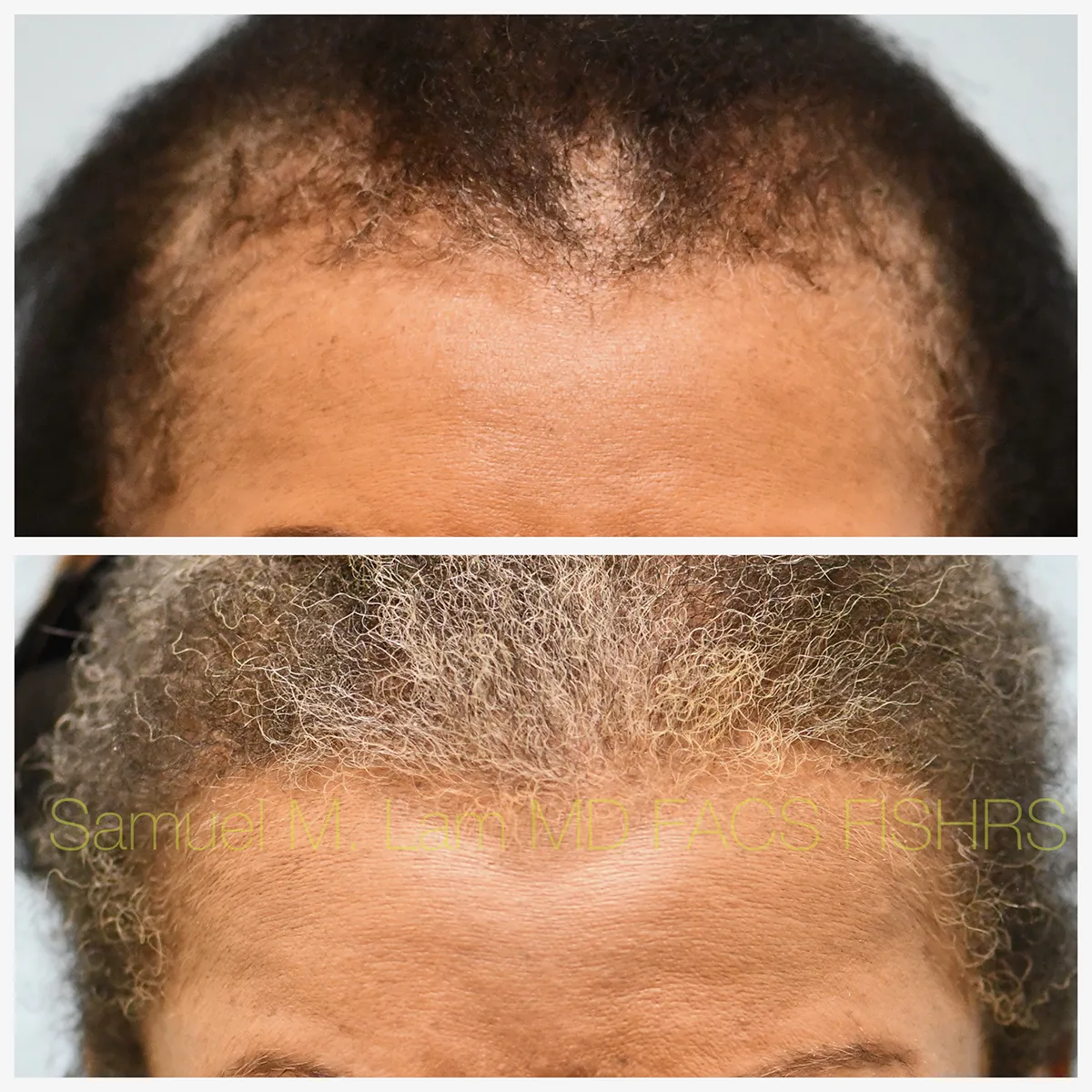 Front View Traction Alopecia Correction Before and After Photo by Dr. Lam Front View Traction Alopecia Correction Before and After Photo by Dr. Lam