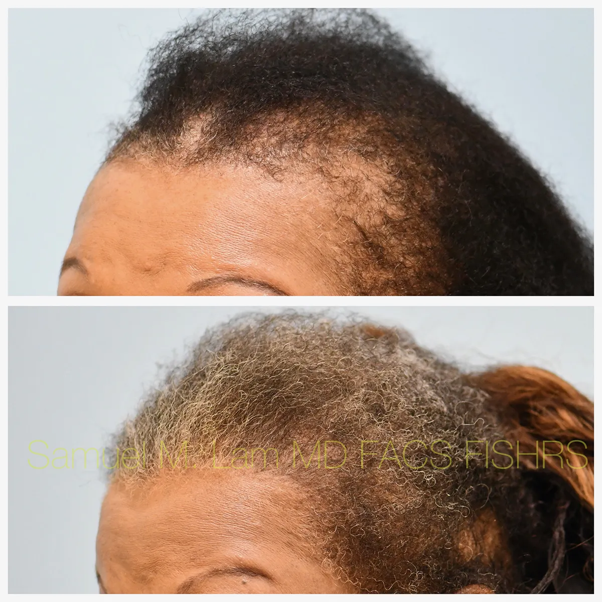 Left Oblique View Traction Alopecia Correction Before and After Photo by Dr. Lam Left Oblique View Traction Alopecia Correction Before and After Photo by Dr. Lam