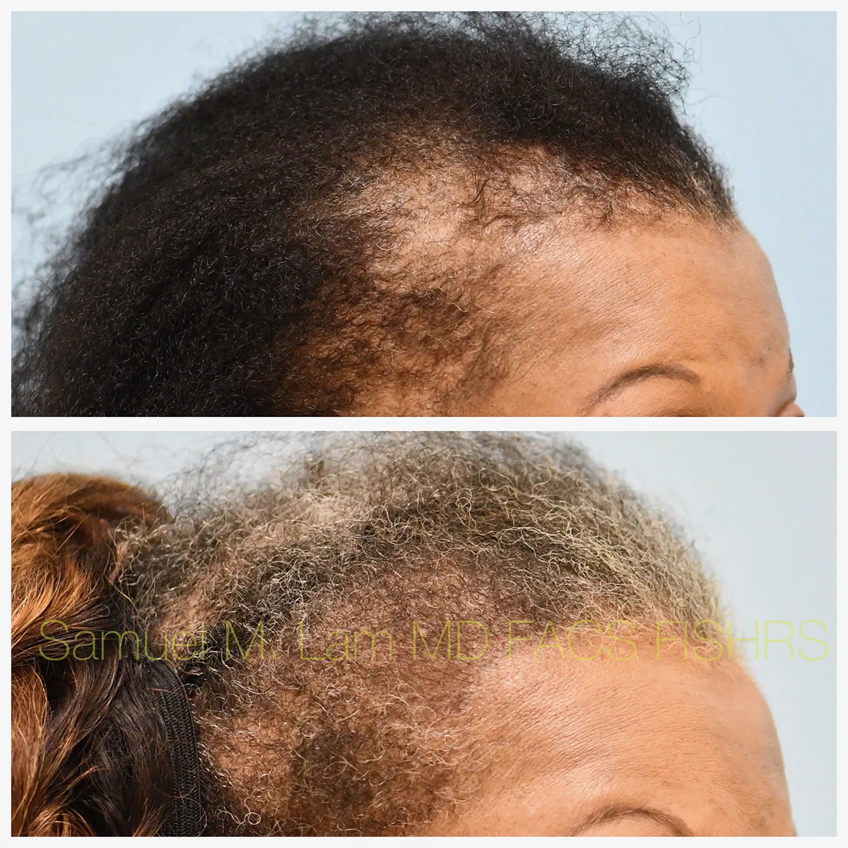 Right Oblique View Traction Alopecia Correction Before and After Photo by Dr. Lam