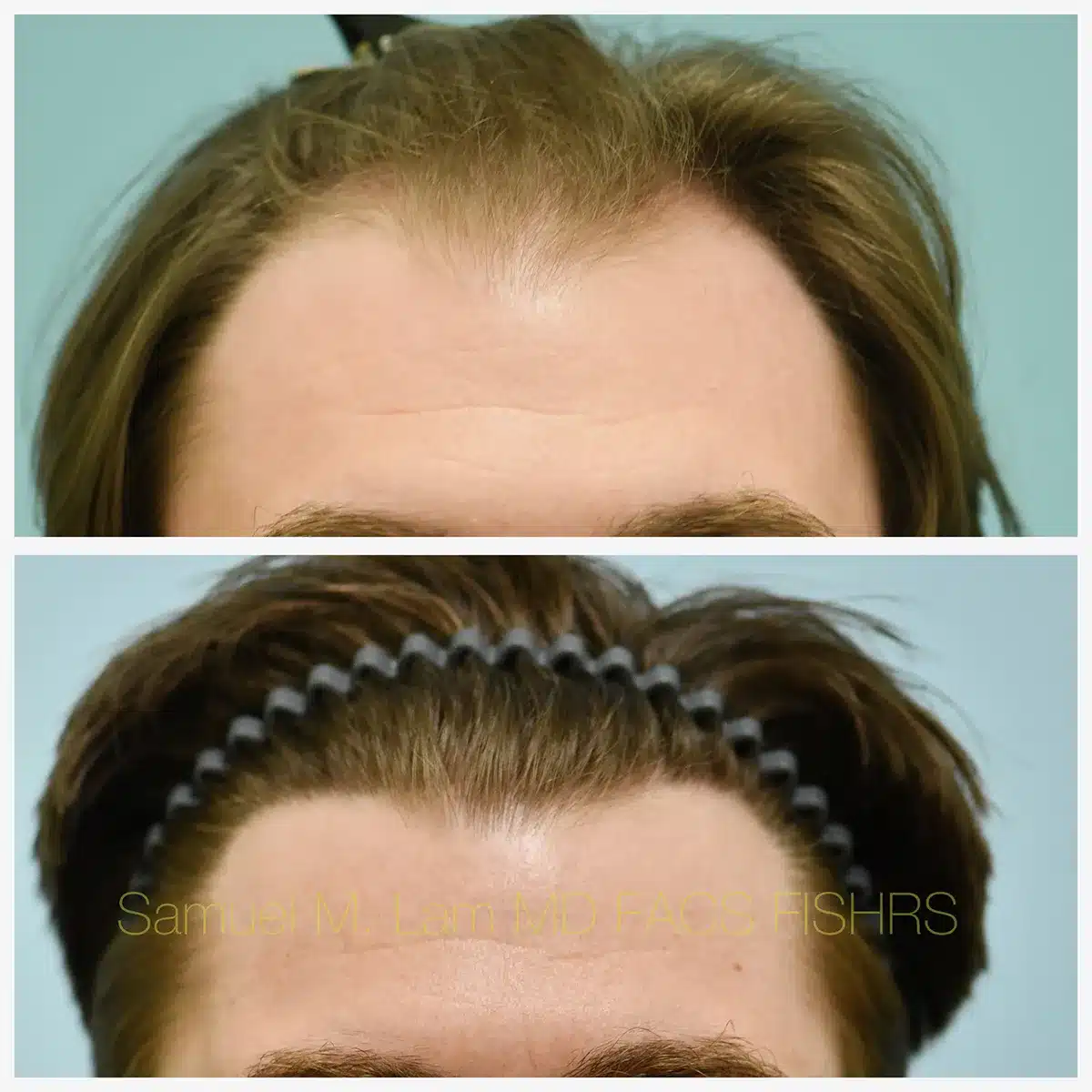 Front View FUE hair transplant Before and After Photo by Dr. Lam