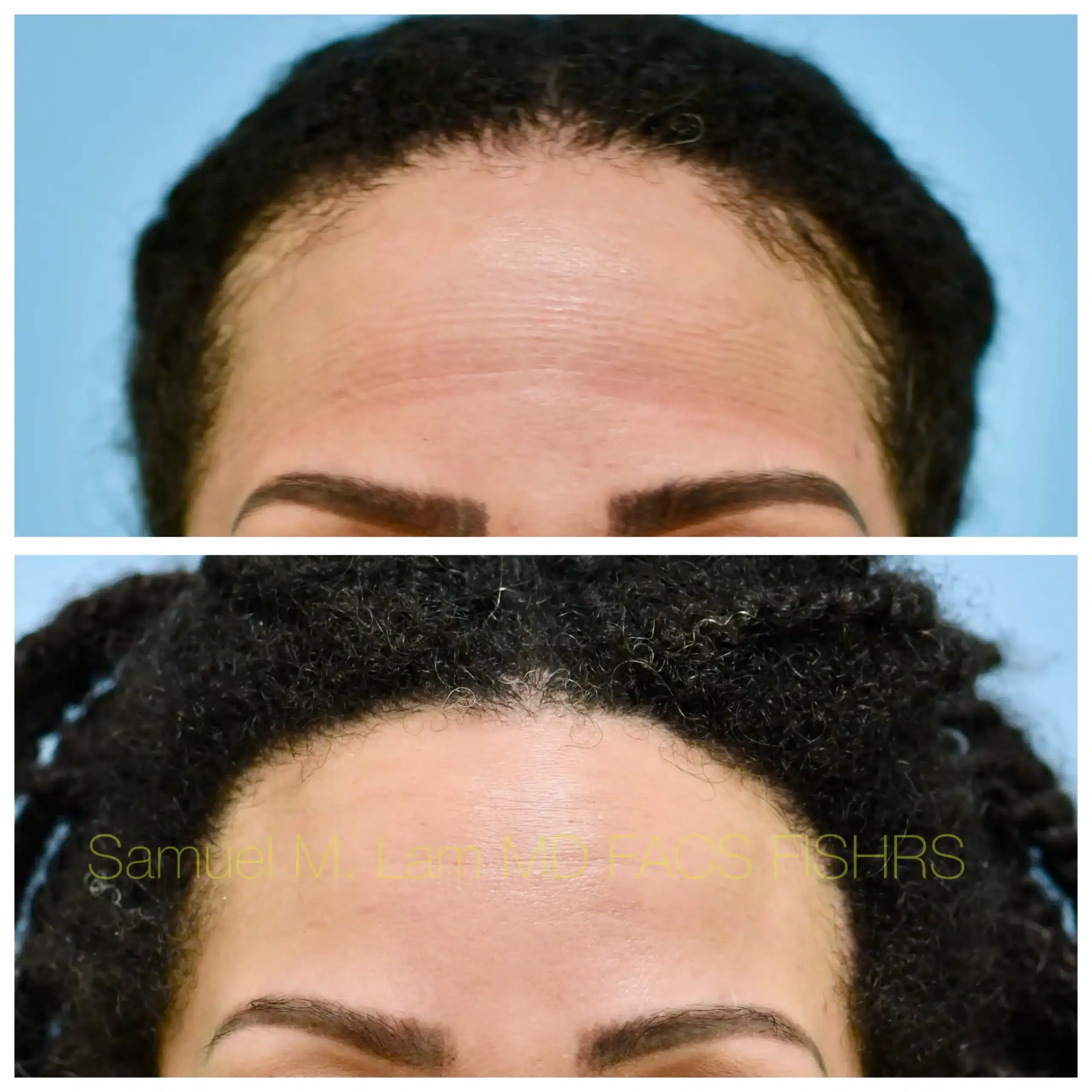 Front View Traction Alopecia hair transplant Before and After Photo by Dr. Lam