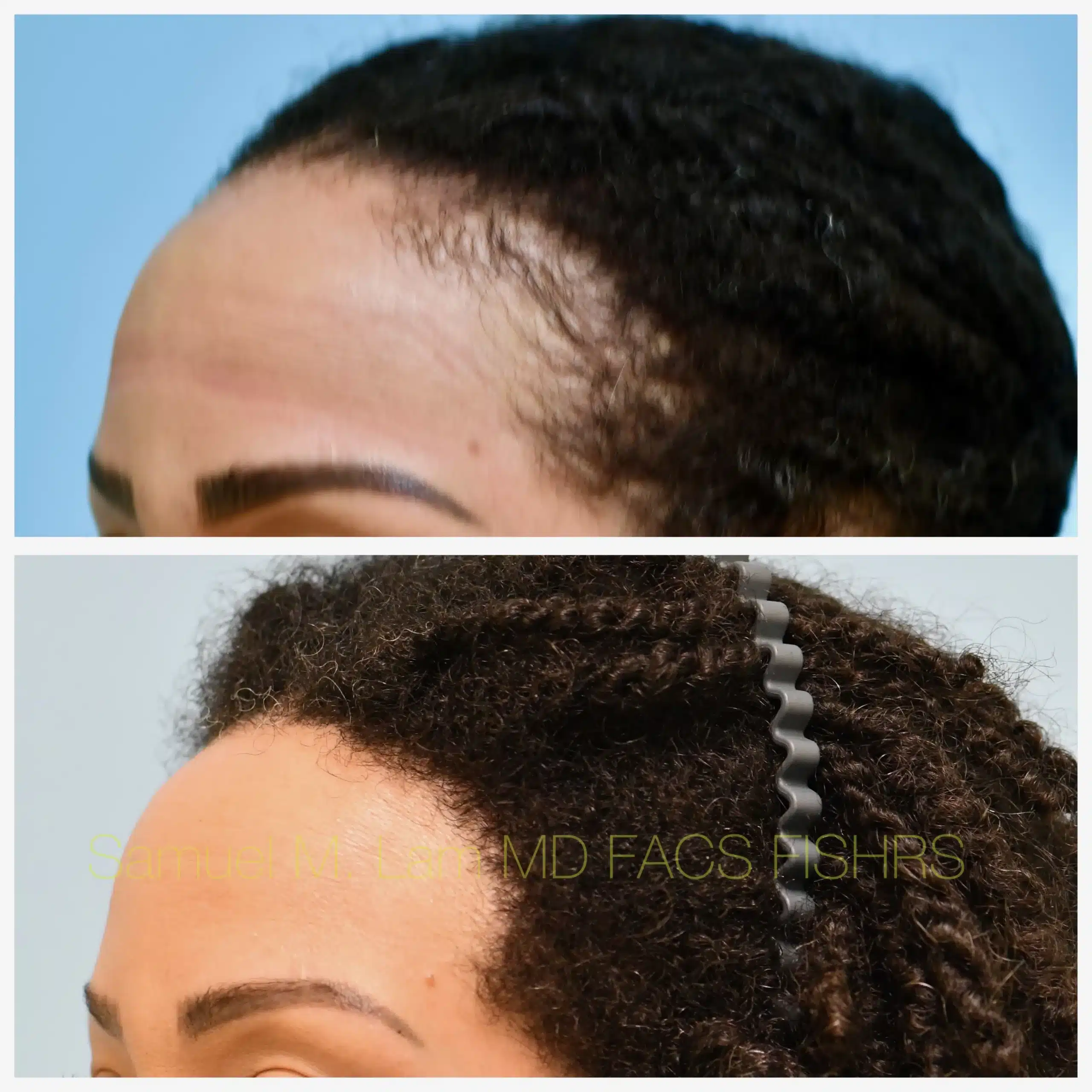Left Oblique View Traction Alopecia hair transplant Before and After Photo by Dr. Lam