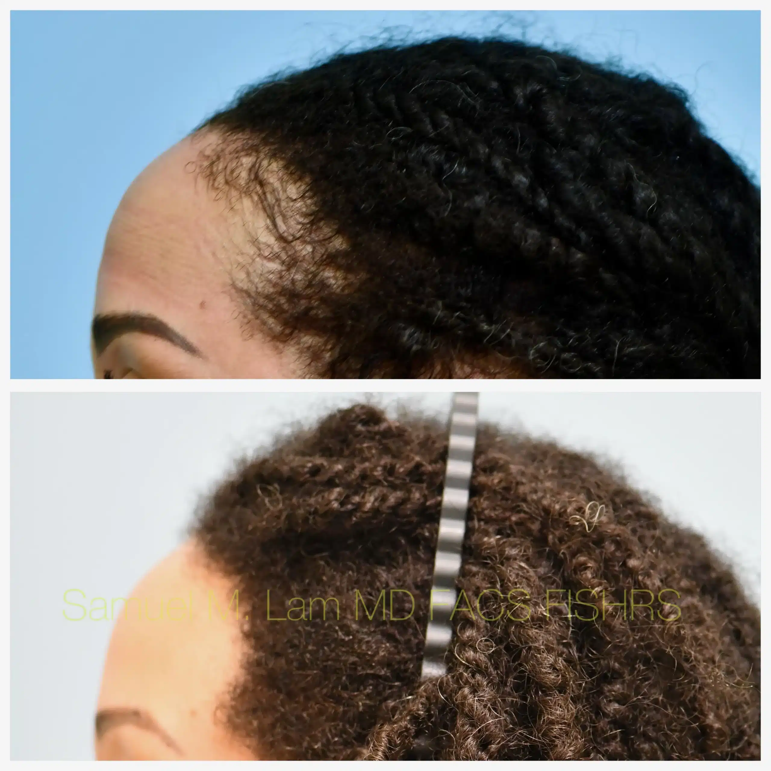 Left Side View Traction Alopecia hair transplant Before and After Photo by Dr. Lam