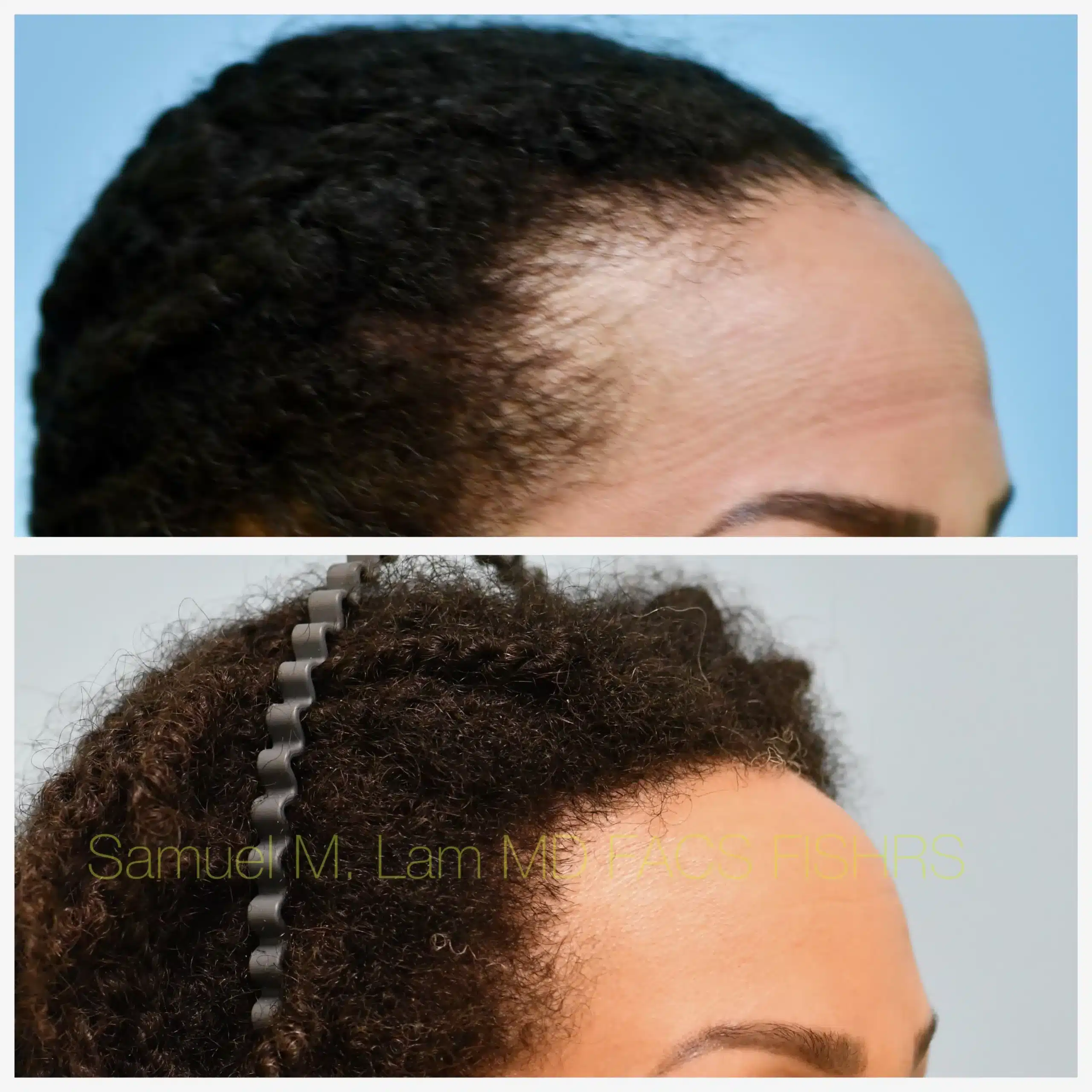 Right Oblique View Traction Alopecia hair transplant Before and After Photo by Dr. Lam