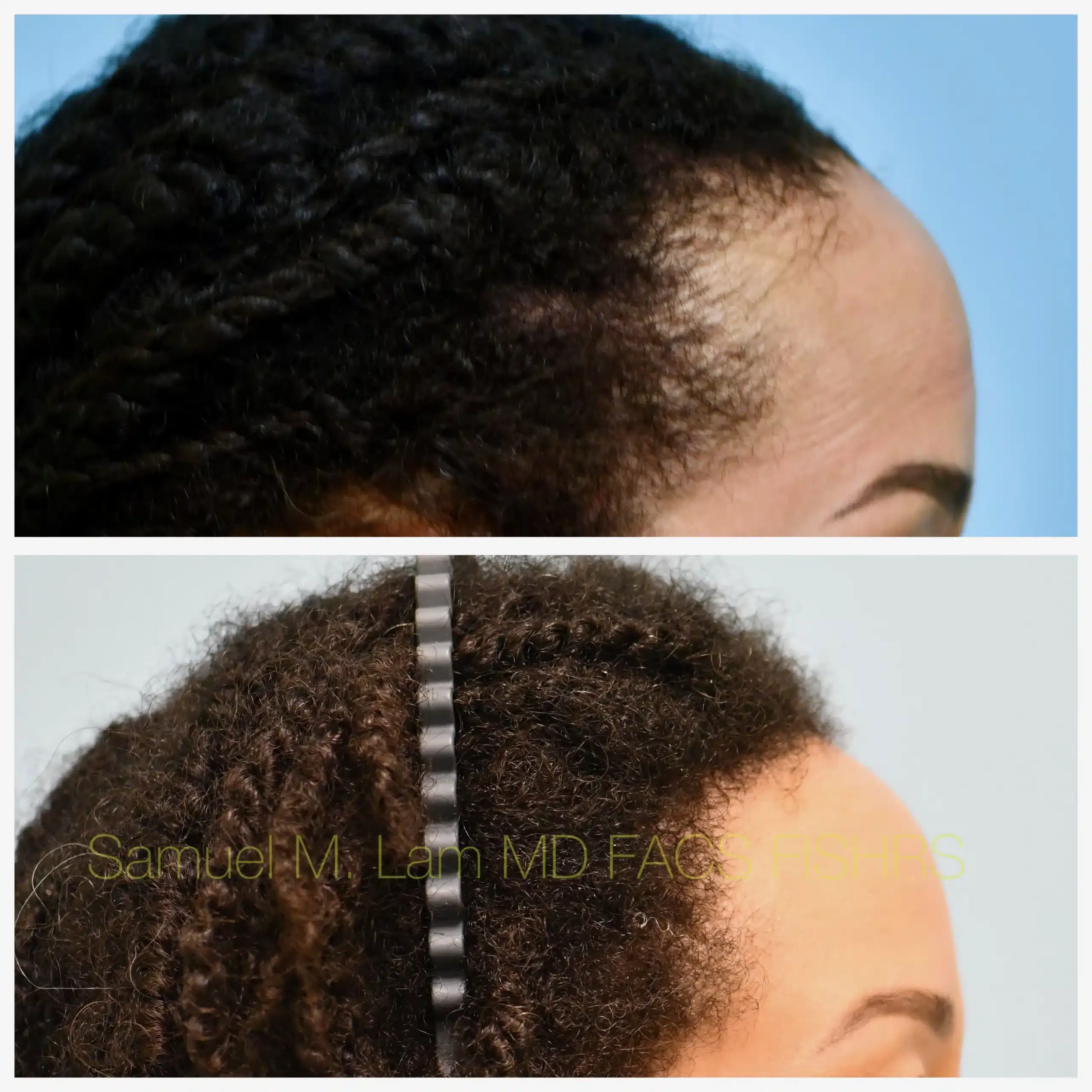 Right Side View Traction Alopecia hair transplant Before and After Photo by Dr. Lam