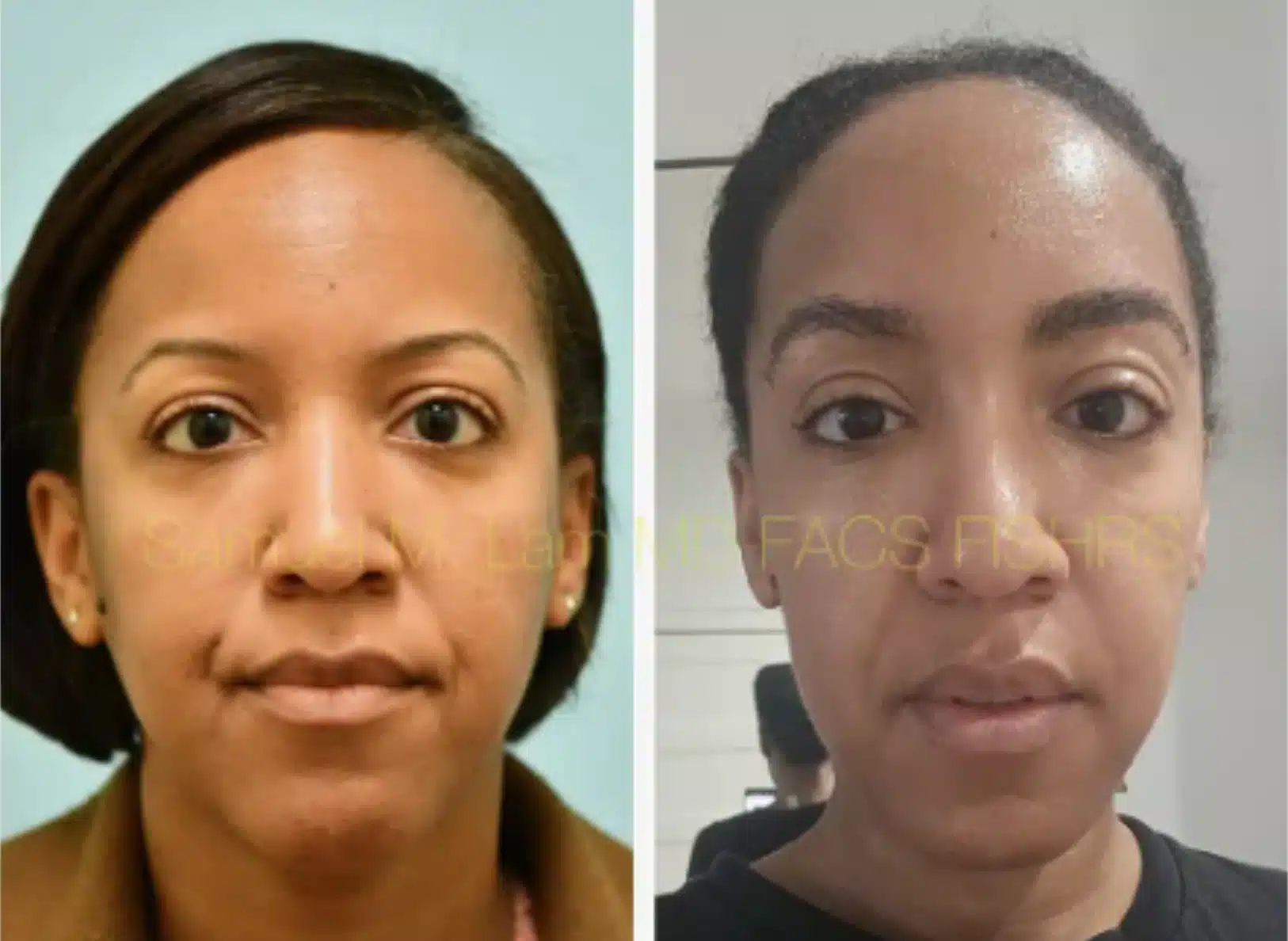 Hair Transplant Results