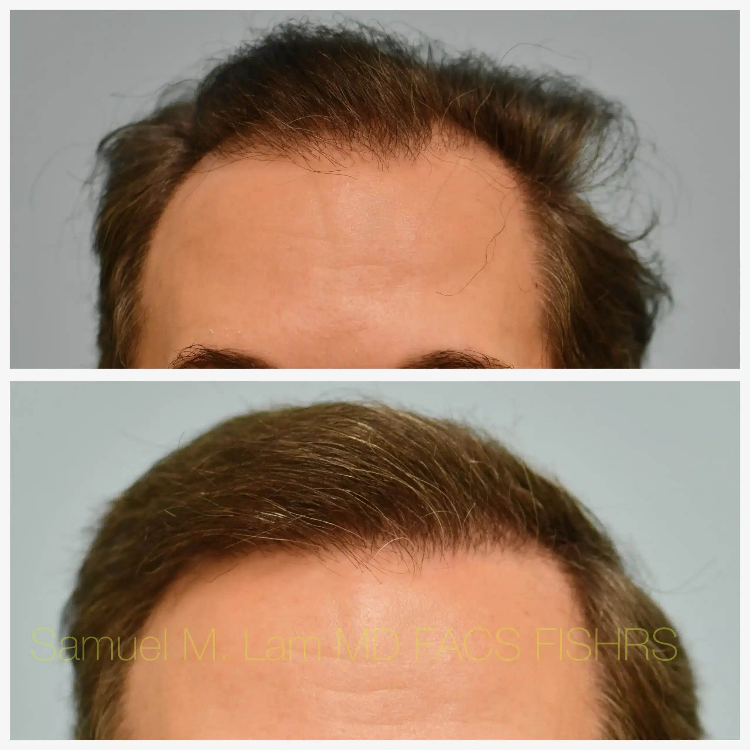 front view hair transplant Before and After Photo by Dr. Lam