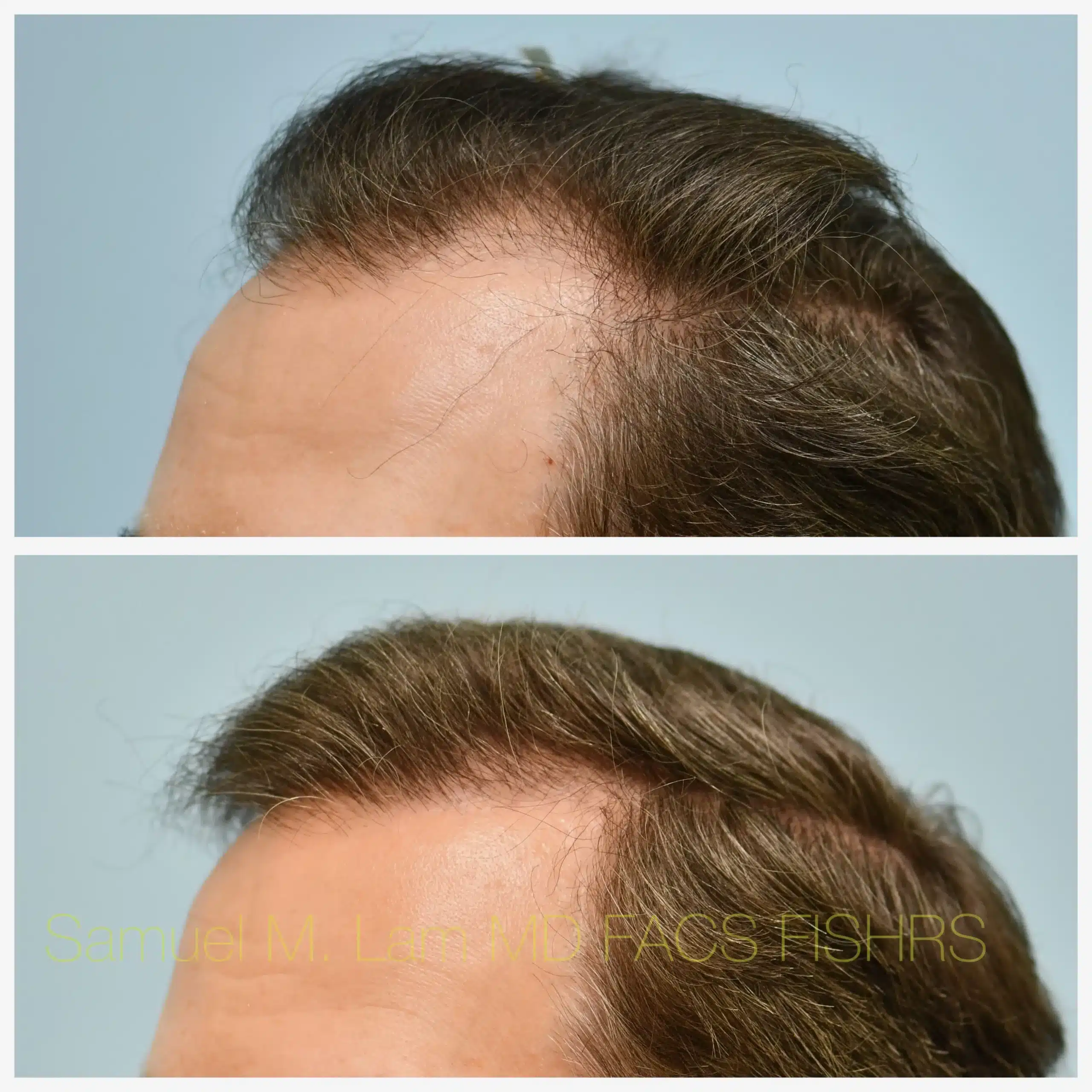 left oblique view hair transplant Before and After Photo by Dr. Lam
