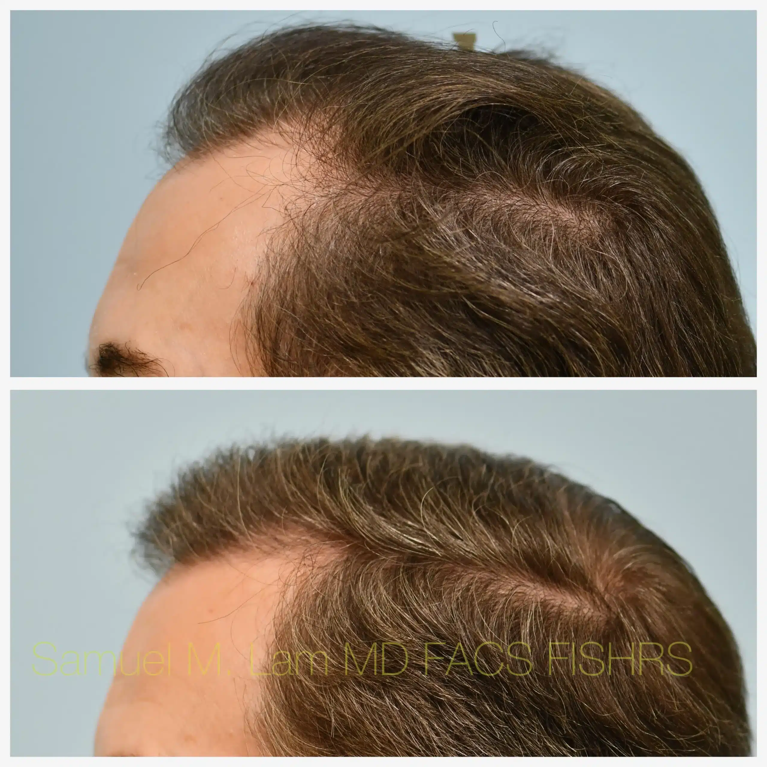 left side view hair transplant Before and After Photo by Dr. Lam