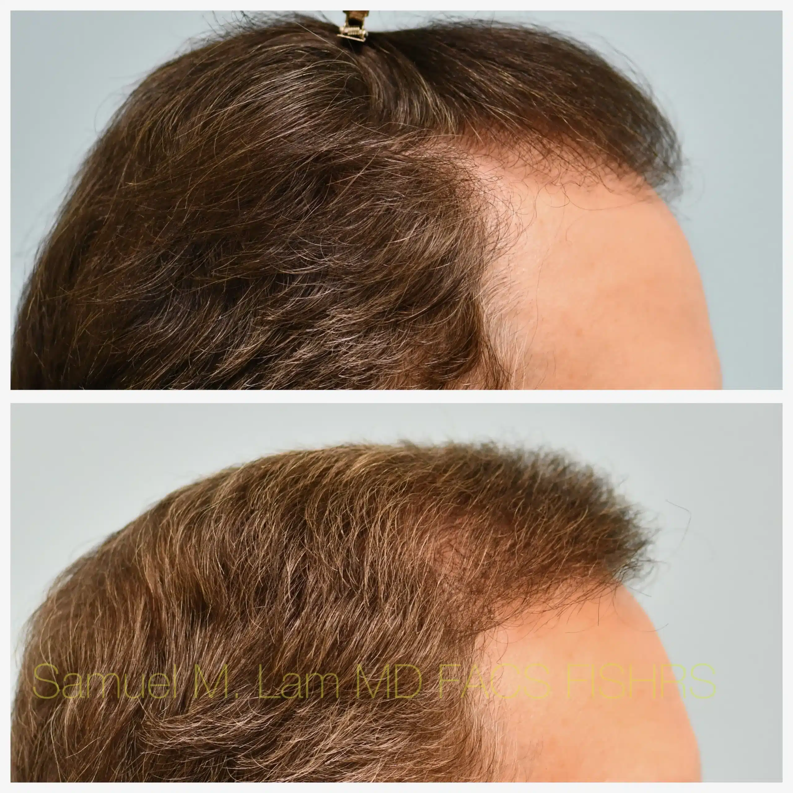 right side view hair transplant Before and After Photo by Dr. Lam