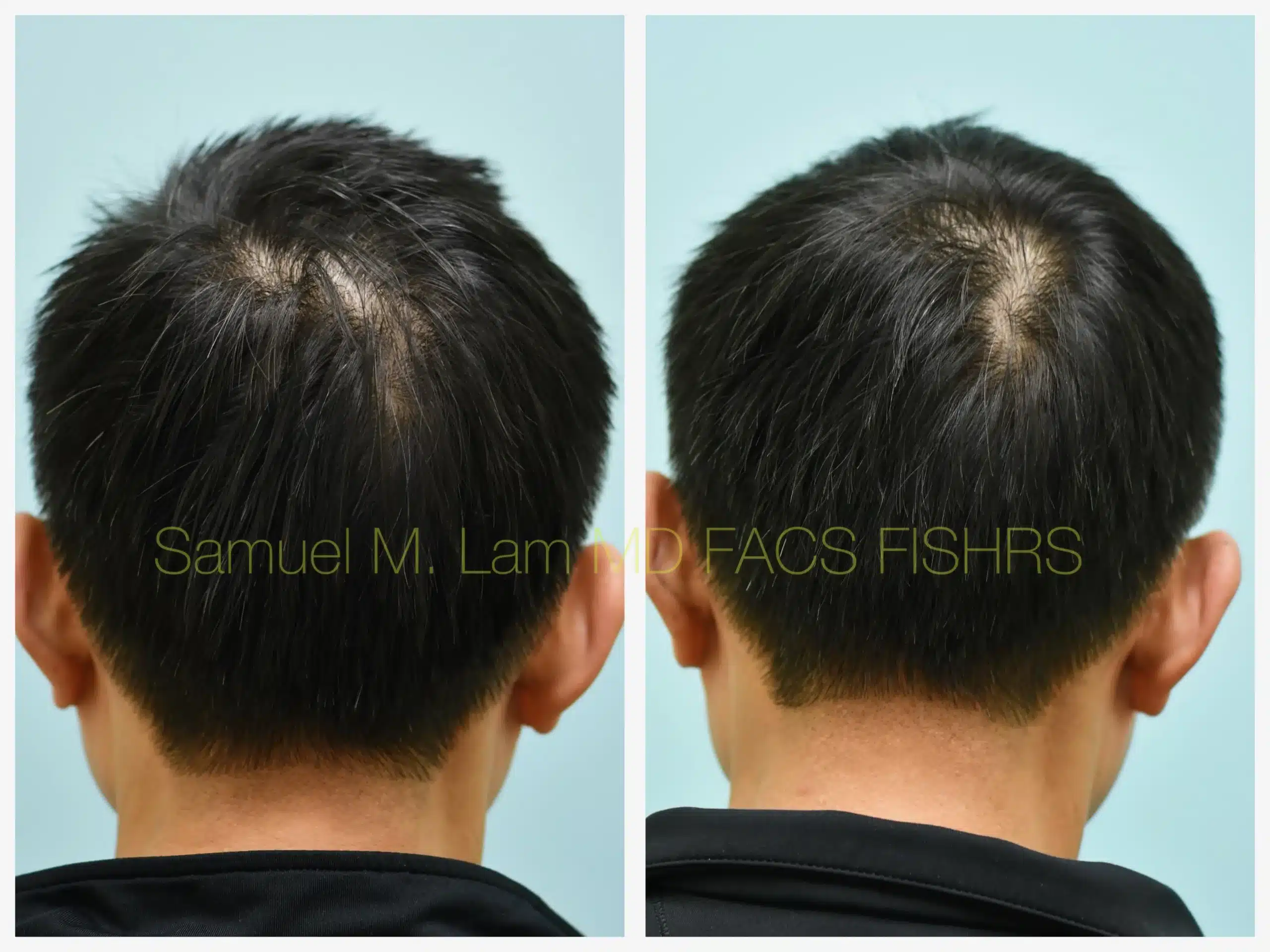 back close up view lasercap Before and After Photo by Dr. Lam back close up view lasercap Before and After Photo by Dr. Lam
