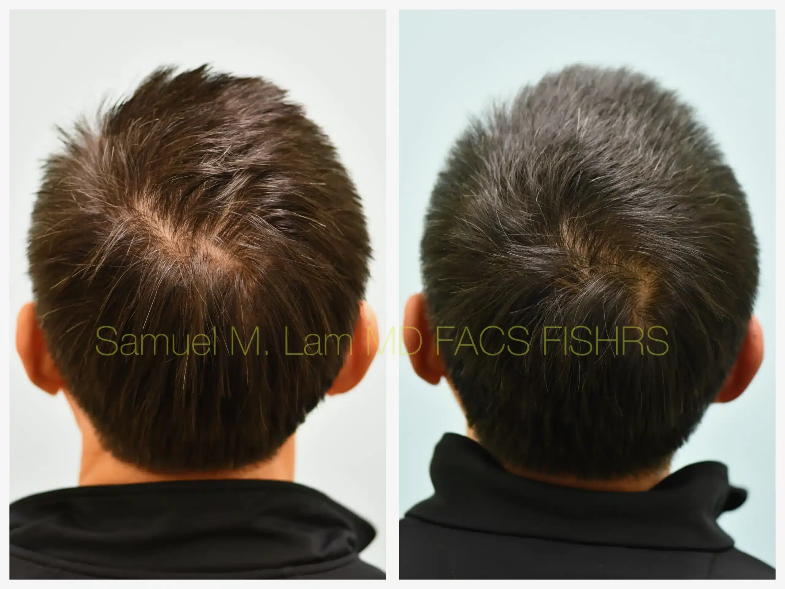 back view lasercap Before and After Photo by Dr. Lam back view lasercap Before and After Photo by Dr. Lam