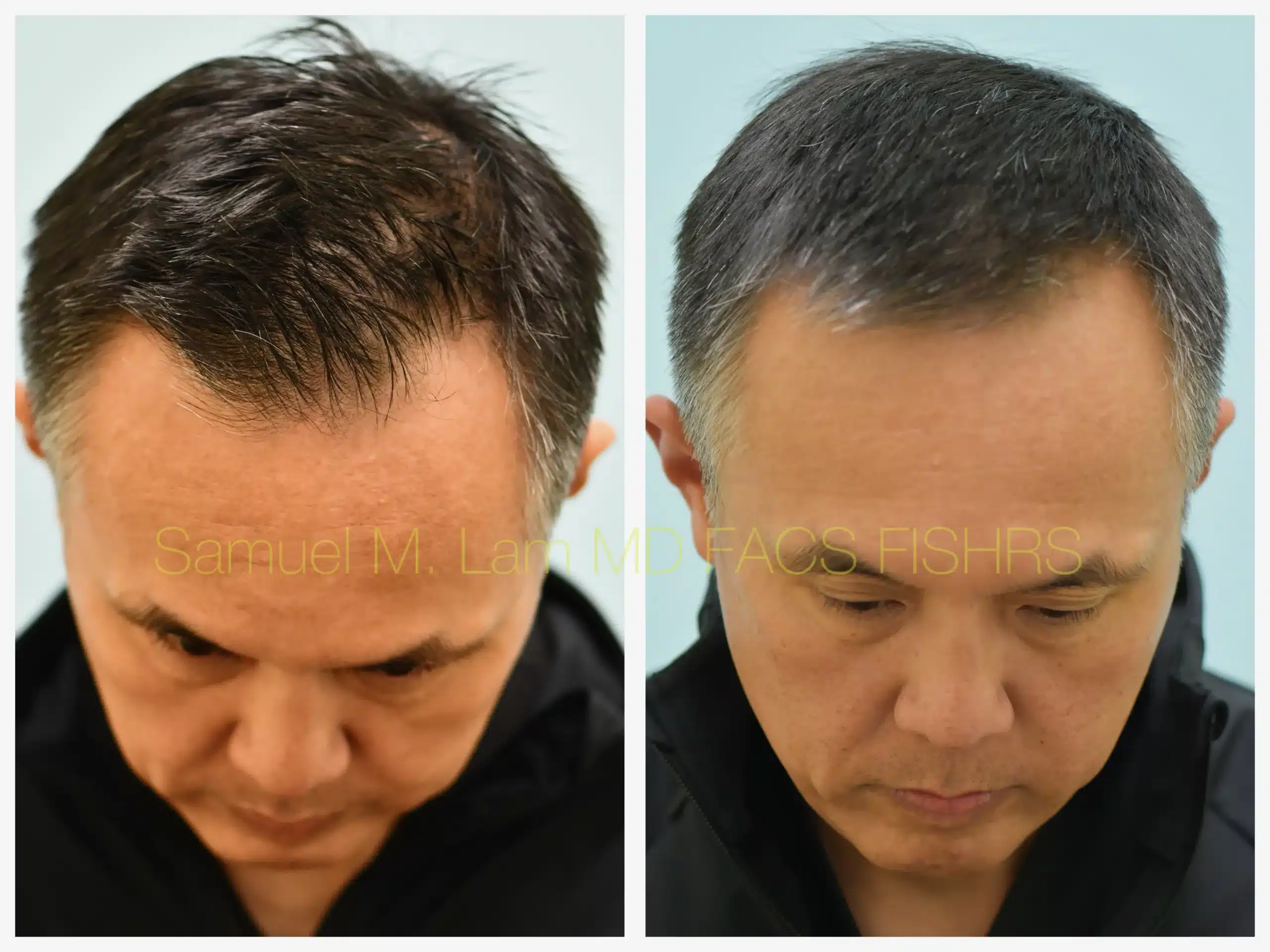 close up view lasercap Before and After Photo by Dr. Lam close up view lasercap Before and After Photo by Dr. Lam