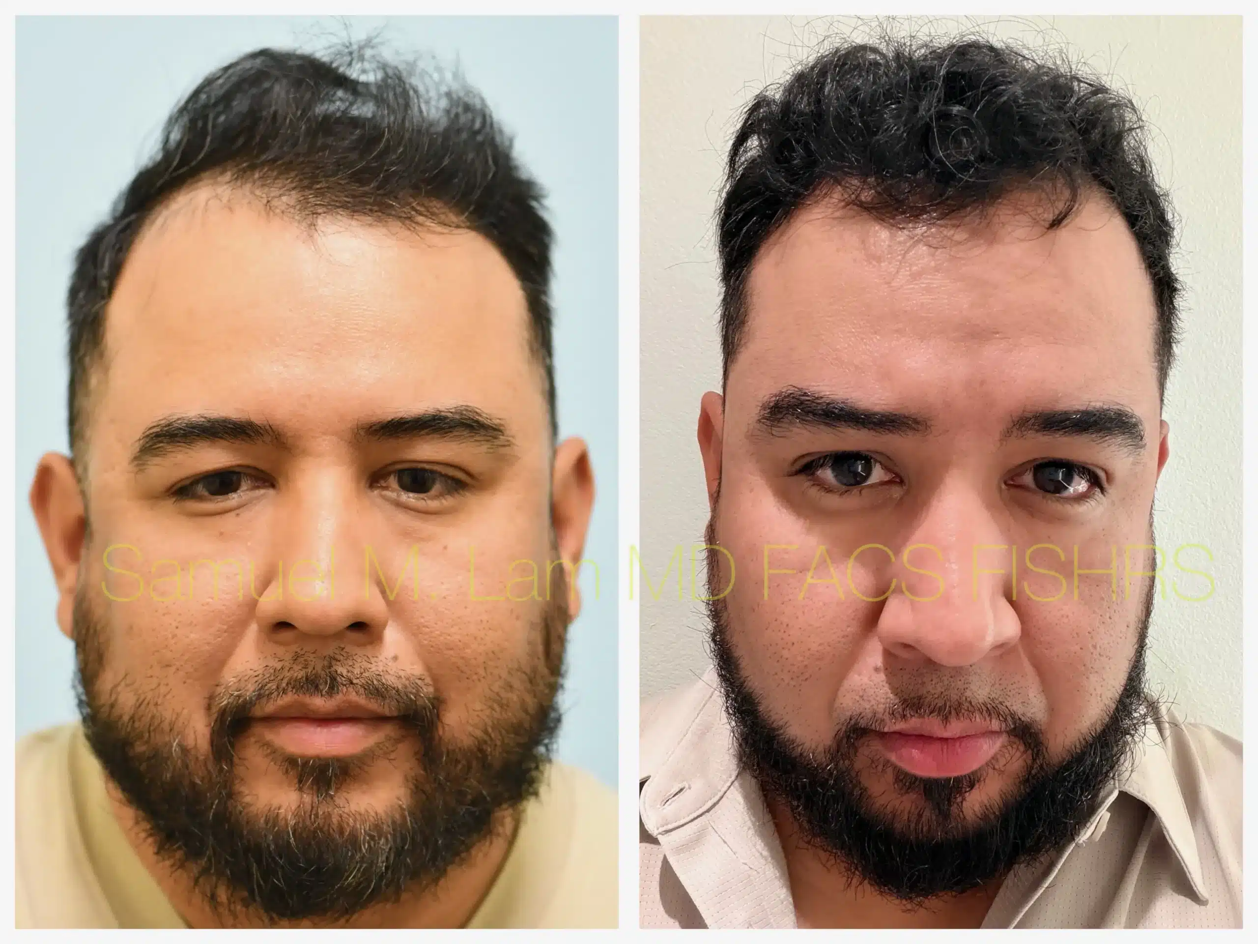 front view PRP and hair stem Before and After Photo by Dr. Lam front view PRP and hair stem Before and After Photo by Dr. Lam
