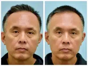 front view lasercap Before and After Photo by Dr. Lam