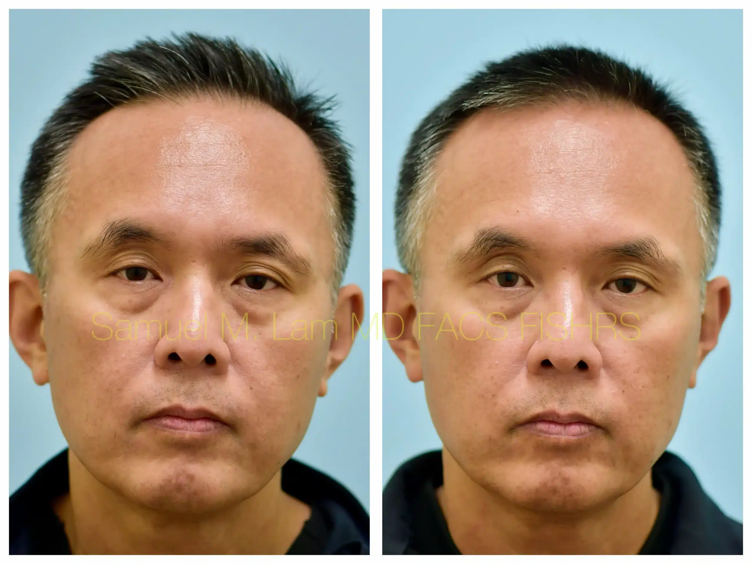 front view lasercap Before and After Photo by Dr. Lam front view lasercap Before and After Photo by Dr. Lam