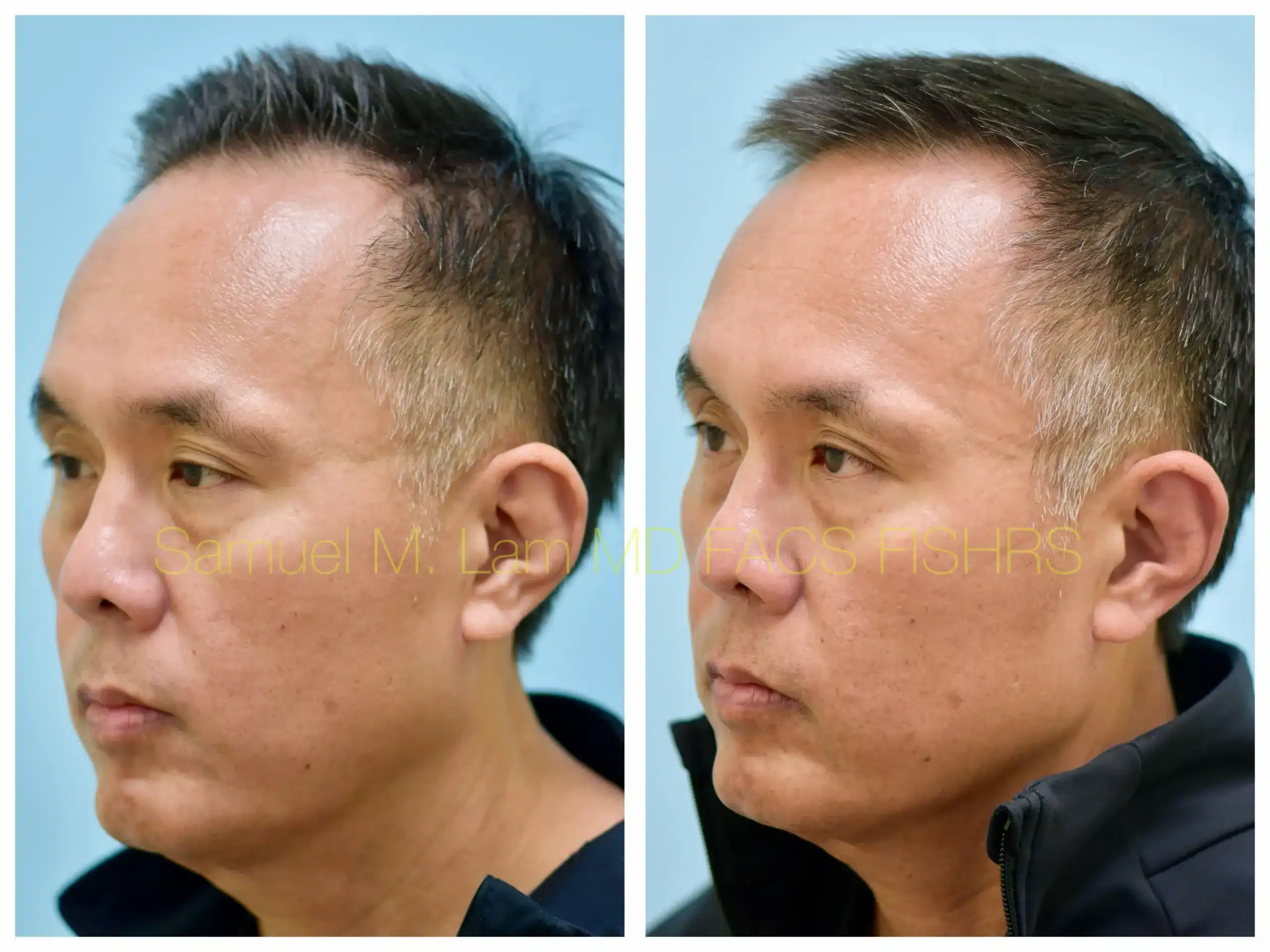 left oblique view lasercap Before and After Photo by Dr. Lam left oblique view lasercap Before and After Photo by Dr. Lam