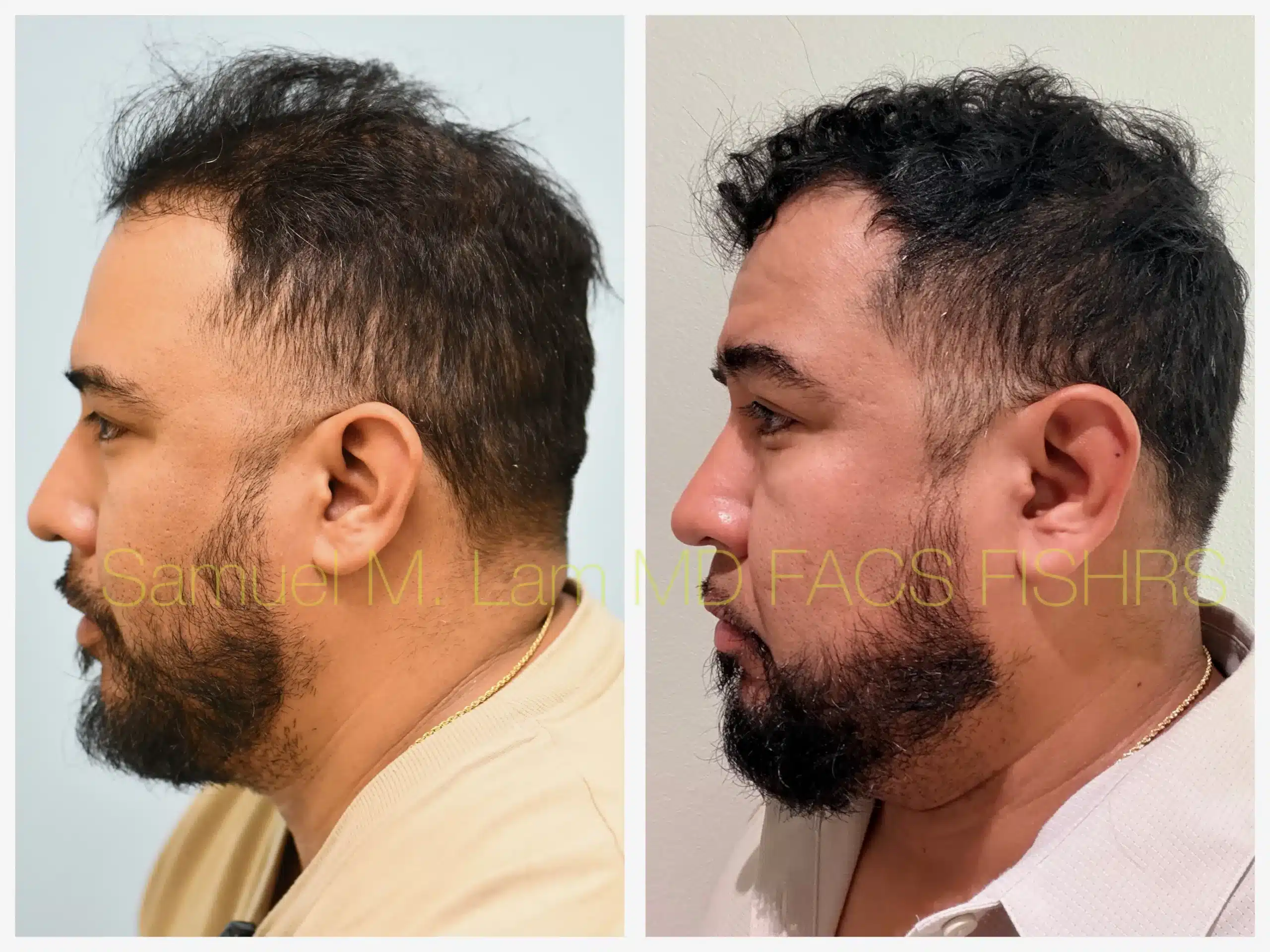 left side view PRP and hair stem Before and After Photo by Dr. Lam left side view PRP and hair stem Before and After Photo by Dr. Lam
