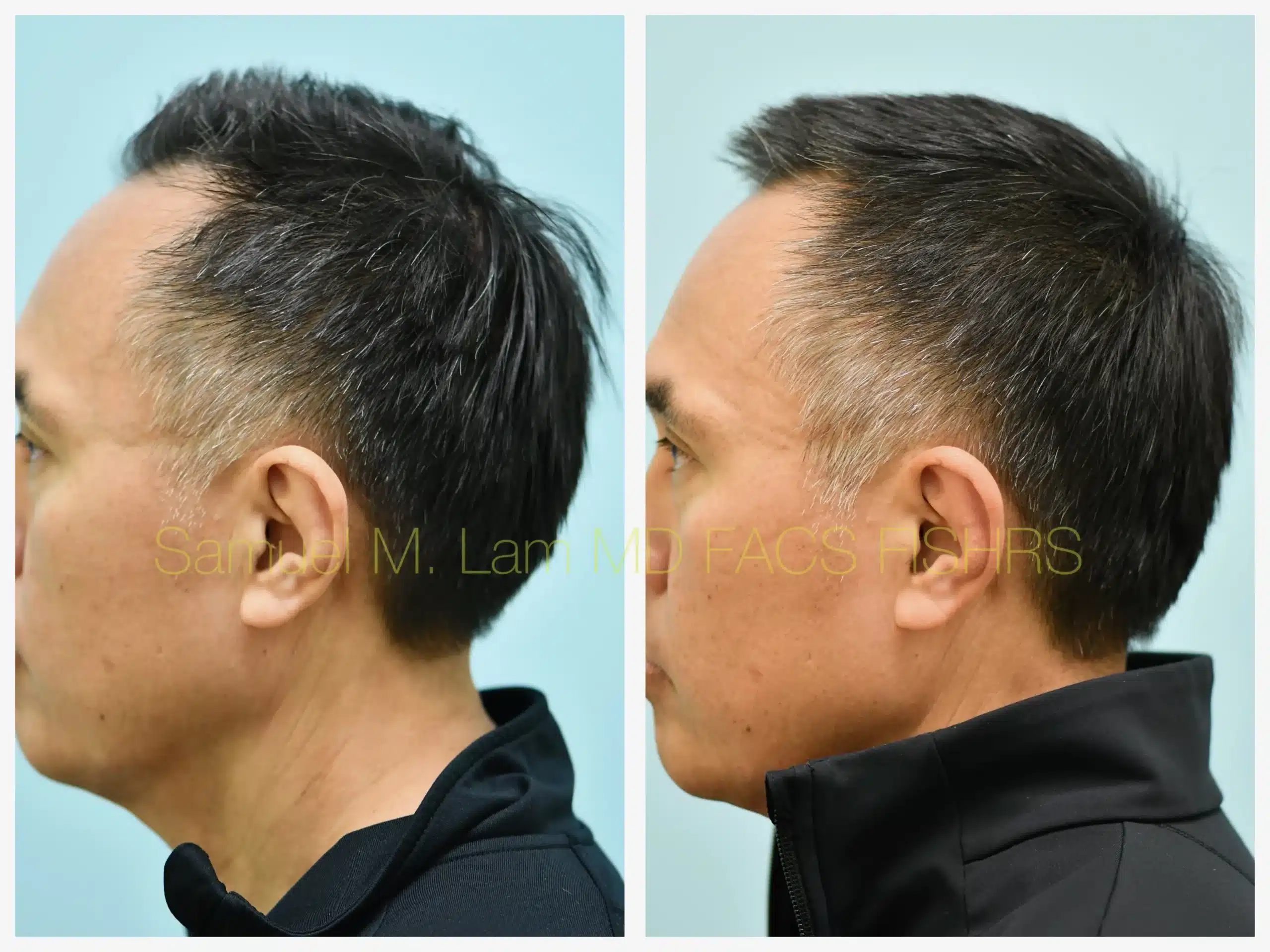 left side view lasercap Before and After Photo by Dr. Lam left side view lasercap Before and After Photo by Dr. Lam