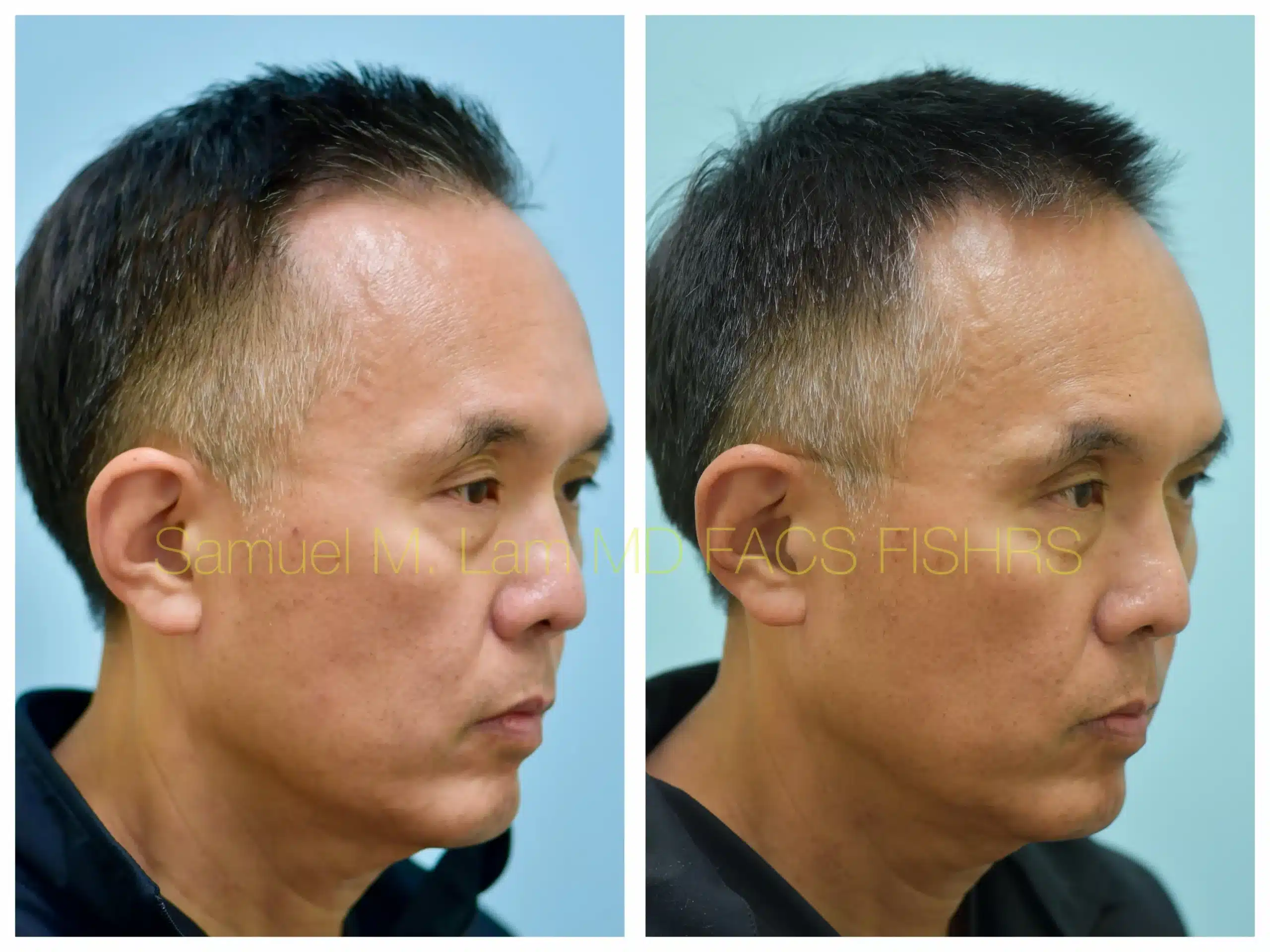 right oblique view lasercap Before and After Photo by Dr. Lam right oblique view lasercap Before and After Photo by Dr. Lam