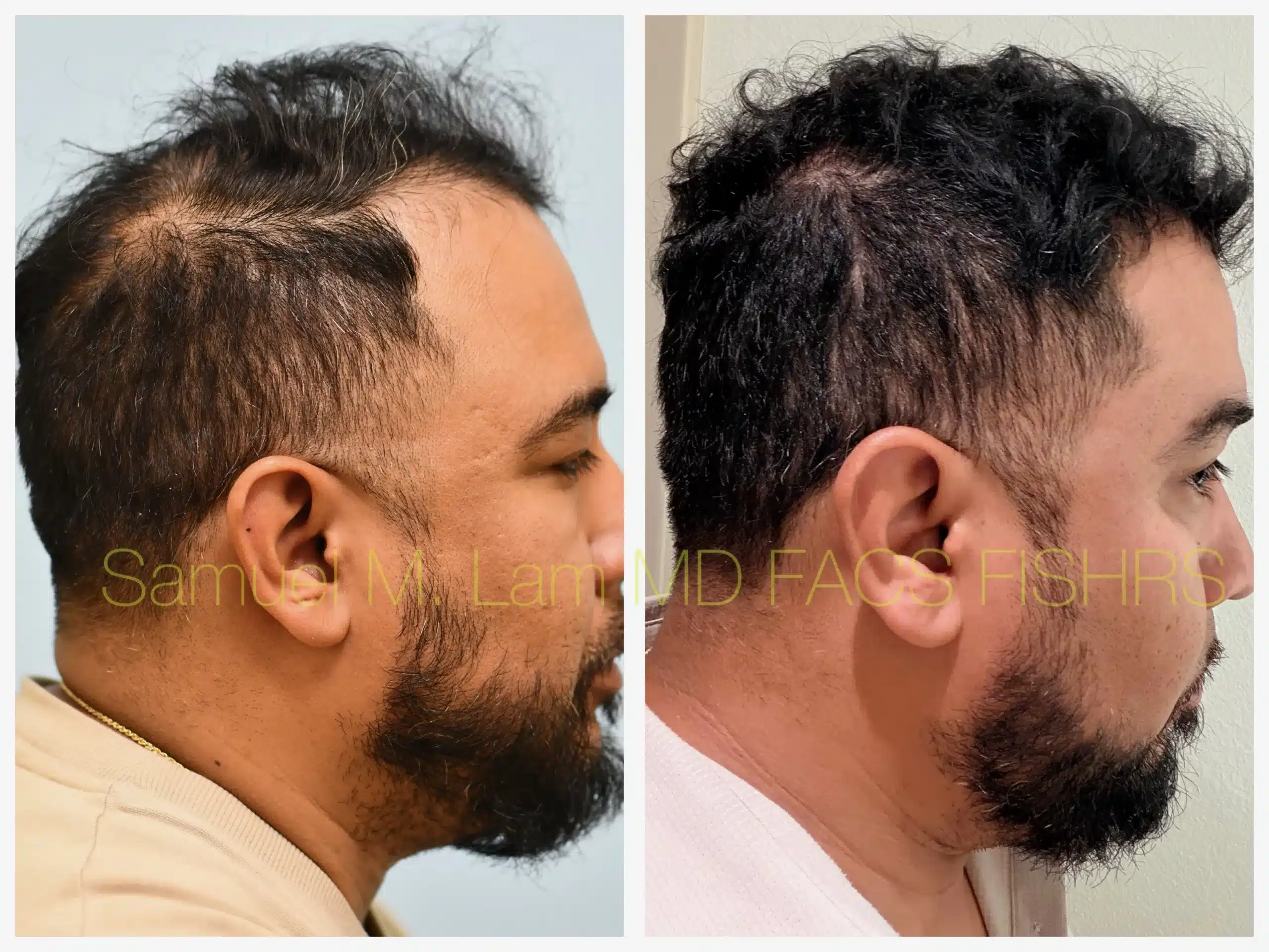 right side view PRP and hair stem Before and After Photo by Dr. Lam right side view PRP and hair stem Before and After Photo by Dr. Lam