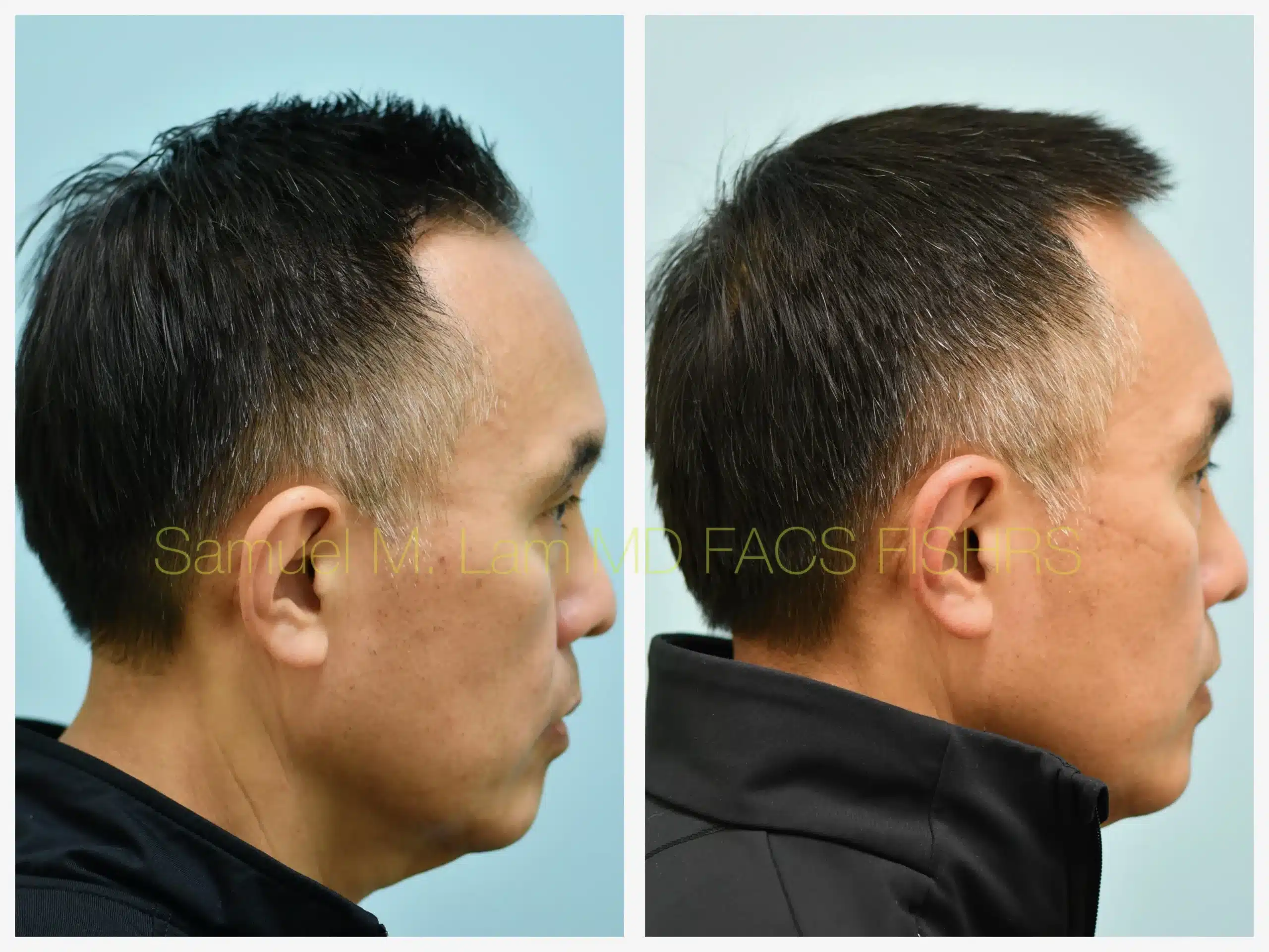 right side view lasercap Before and After Photo by Dr. Lam right side view lasercap Before and After Photo by Dr. Lam