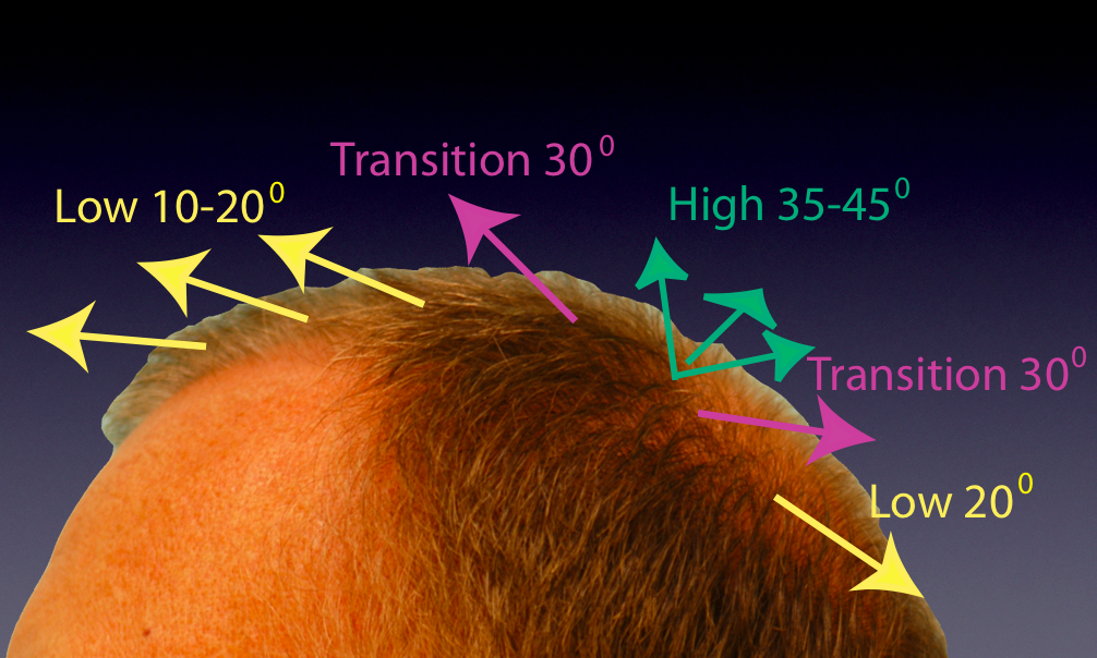 Hair Transplant for the Crown Part 4: Creating the Right Angles and  Transitions | Lam, Sam ()