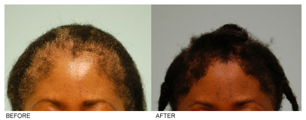 Traction Alopecia Hair Restoration - Female Patient age 50