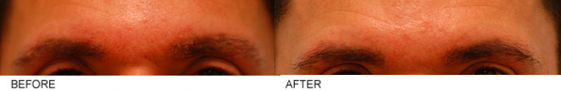 Male Eyebrow Hair Restoration