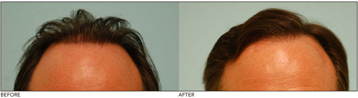 Natural Hair Transplants Results Even Close Up