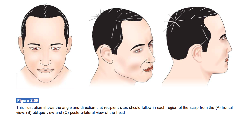 Global Hair Angles in Hair Transplant