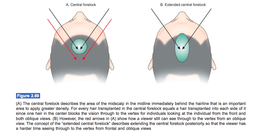 hair transplant central forelock