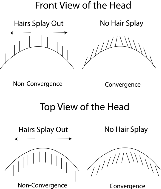 hair transplant convergence