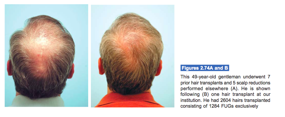 hair transplant crown vertex