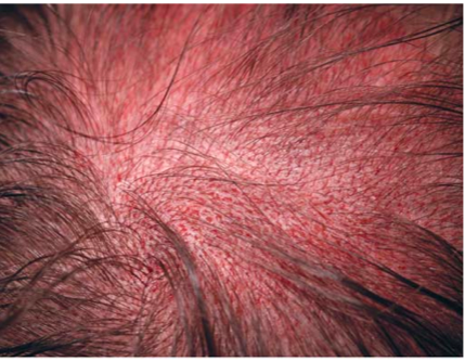 hair transplant transitions