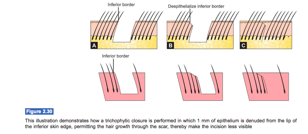 Hair Transplant Trichophytic Closure