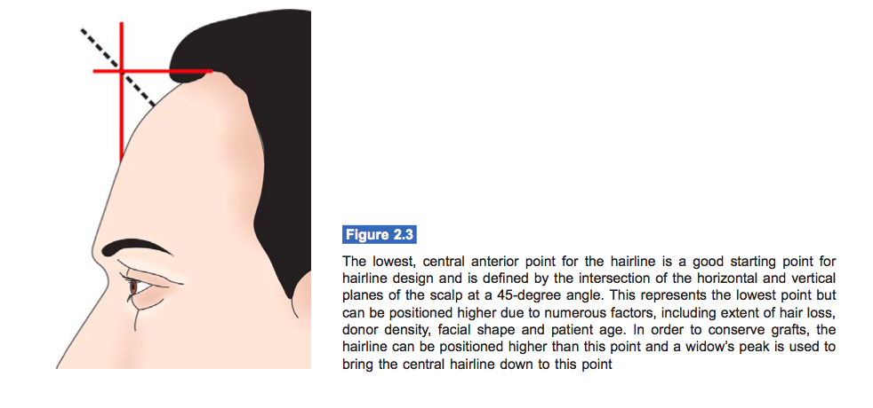 hairline-lowest-acceptable-hair-transplant