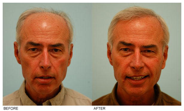 Artistry in hair restoration