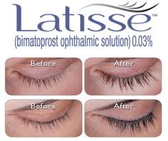 Bimatoprost Latisse For Hair Loss Lam Sam Hairtx Com