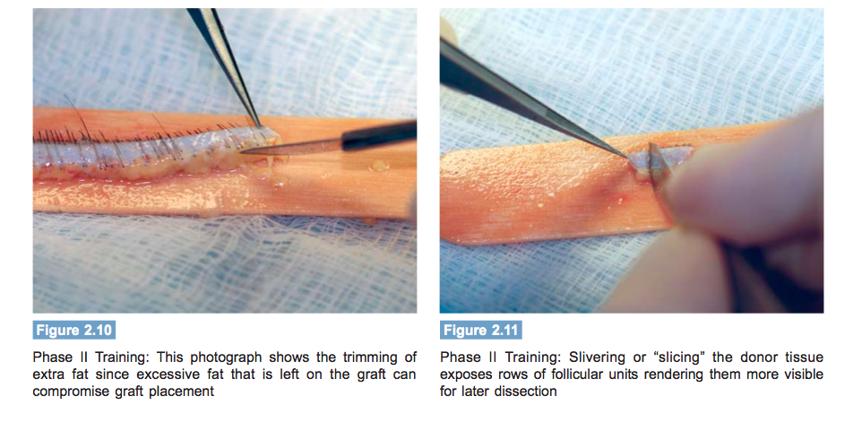 hair transplant assistant training - phase 2