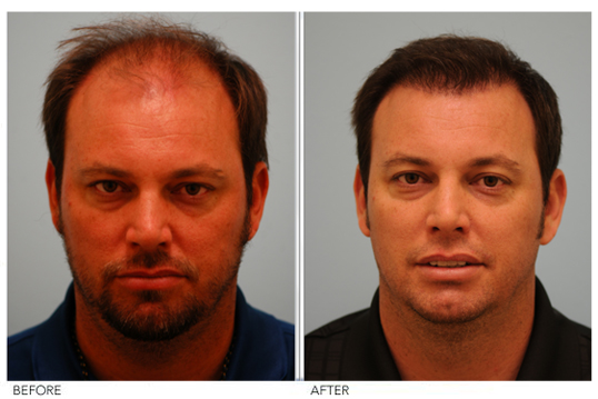 Hair Transplant Hair Density