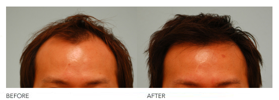 Asian Hair Transplant Before and After