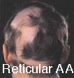 aa-reticular
