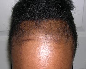 black-hair-traction-alopecia