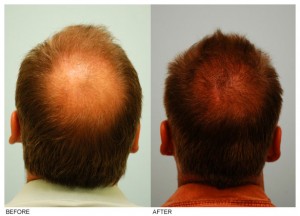Crown Hair Transplant Dallas | Hair Grafting Procedures Plano, TX